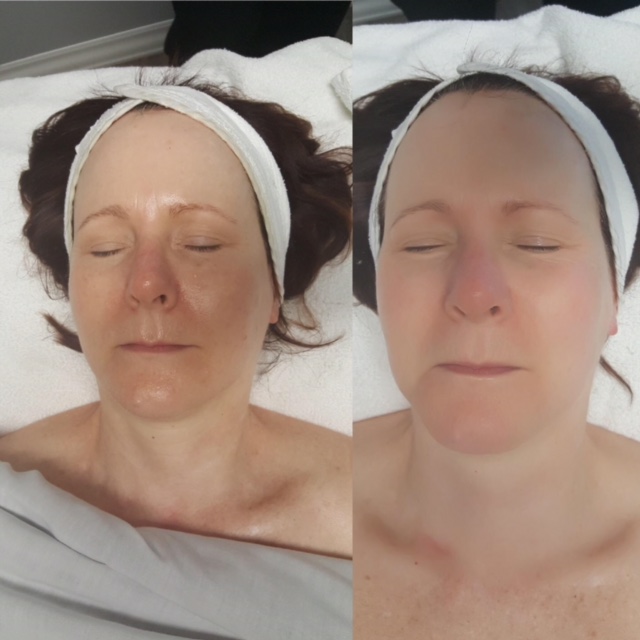 Before and After of Yonka Essential White Facial treatment