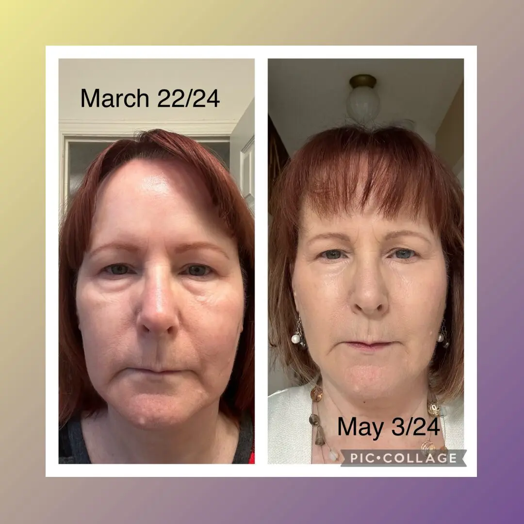 Before and after comparison of woman's face.