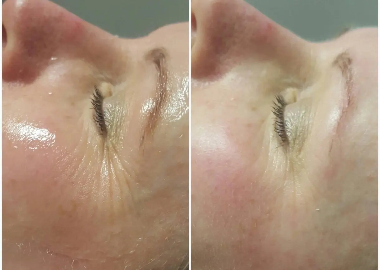 Before & after wrinkle treatment. Before & after wrinkle treatment.