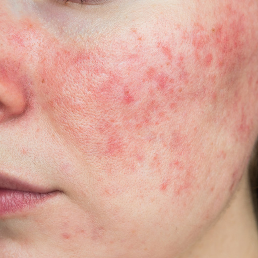 Stress and Rosacea