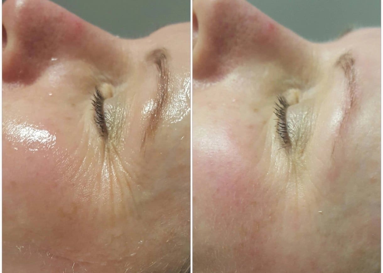 Before & after wrinkle treatment.