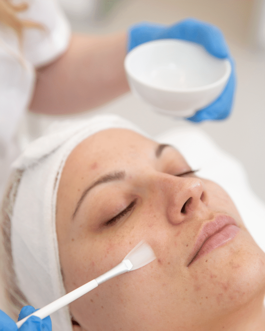 facial peel